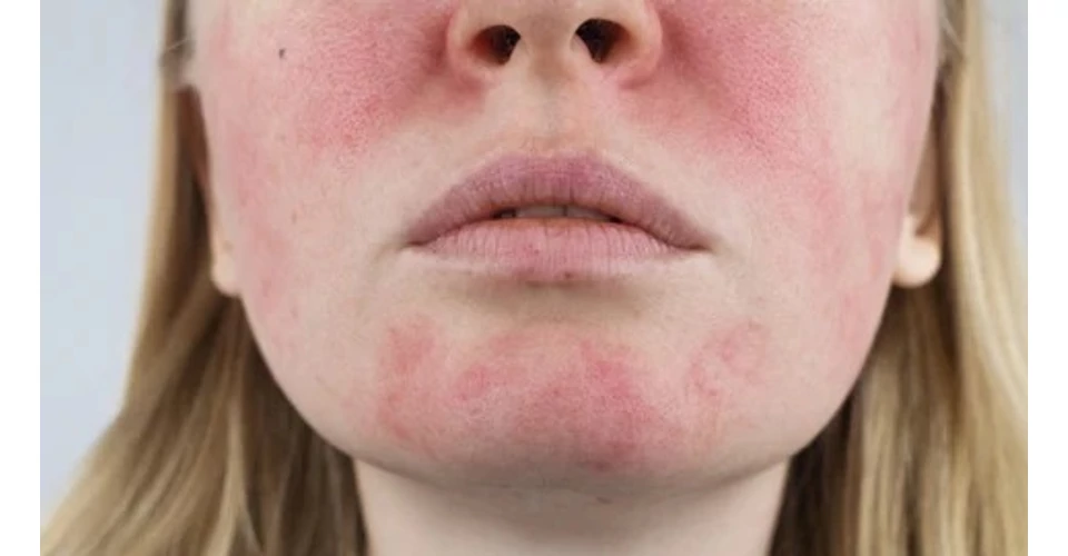 A retinoidok tényleg csodaszerek?